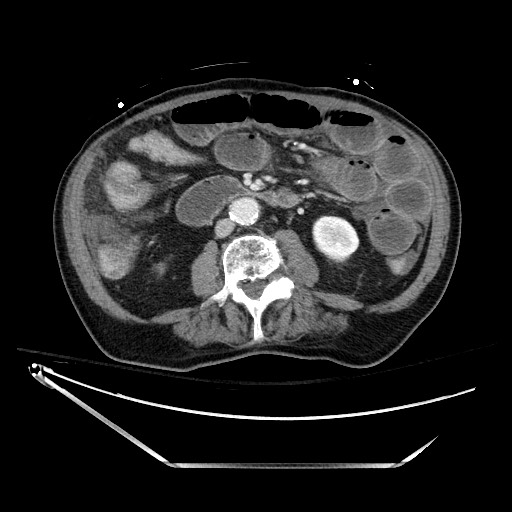 Closed loop obstruction due to adhesive band, resulting in small bowel ischemia and resection (Radiopaedia 83835-99023 D 79).jpg