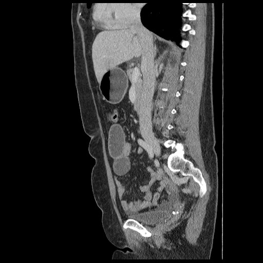 Closed loop small bowel obstruction (Radiopaedia 65403-74451 C 44).jpg