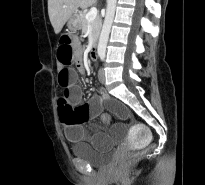 Closed loop small bowel obstruction (Radiopaedia 71211-81508 C 76).jpg