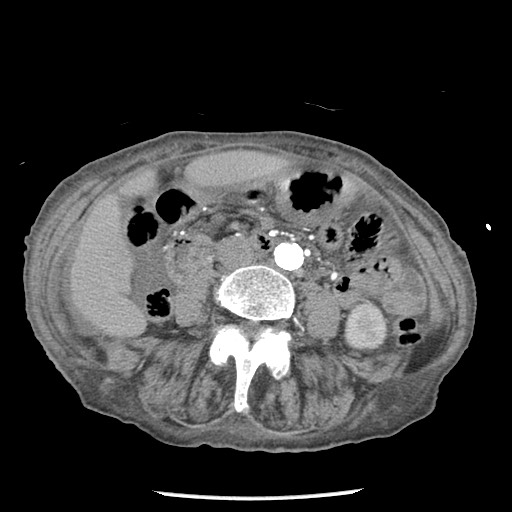 Closed loop small bowel obstruction - adhesions and infarct (Radiopaedia 85125-100678 A 92).jpg