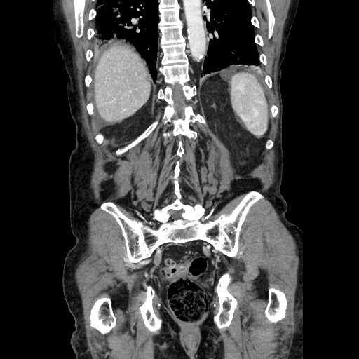 File:Closed loop small bowel obstruction - adhesive disease and hemorrhagic ischemia (Radiopaedia 86831-102990 B 99).jpg