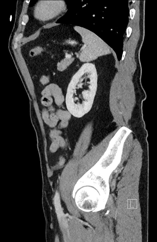 Closed loop small bowel obstruction - internal hernia (Radiopaedia 57806-64778 C 32).jpg