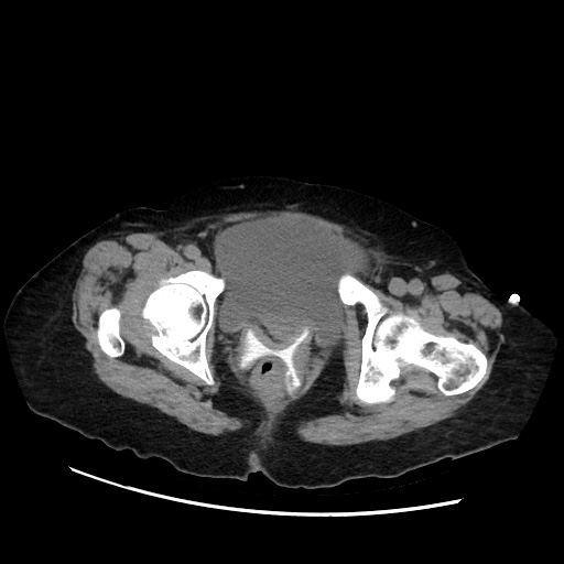 Closed loop small bowel obstruction due to adhesive band, with intramural hemorrhage and ischemia (Radiopaedia 83831-99017 Axial non-contrast 151).jpg