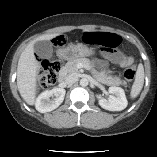 File:Closed loop small bowel obstruction due to trans-omental herniation (Radiopaedia 35593-37109 A 33).jpg