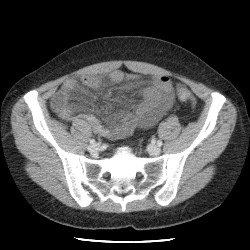 Closed loop small bowel obstruction due to trans-omental herniation (Radiopaedia 35593-37109 A 65).jpg