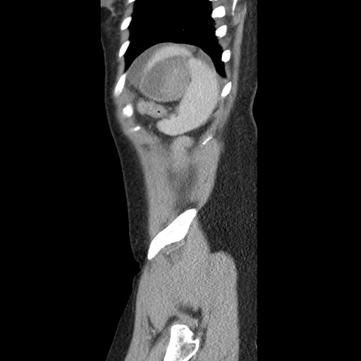 Closed loop small bowel obstruction due to trans-omental herniation (Radiopaedia 35593-37109 C 58).jpg
