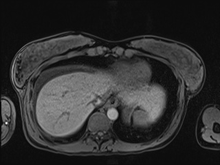 Closed loop small bowel obstruction in pregnancy (MRI) (Radiopaedia 87637-104031 Axial T1 fat sat 15).jpg