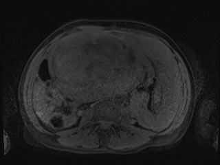 Closed loop small bowel obstruction in pregnancy (MRI) (Radiopaedia 87637-104031 Axial T1 fat sat 71).jpg