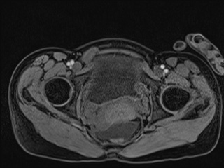 Closed loop small bowel obstruction in pregnancy (MRI) (Radiopaedia 87637-104031 G 20).jpg