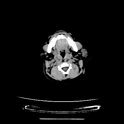 Cloverleaf skull (Radiopaedia 91901-109710 Axial non-contrast 27).jpg