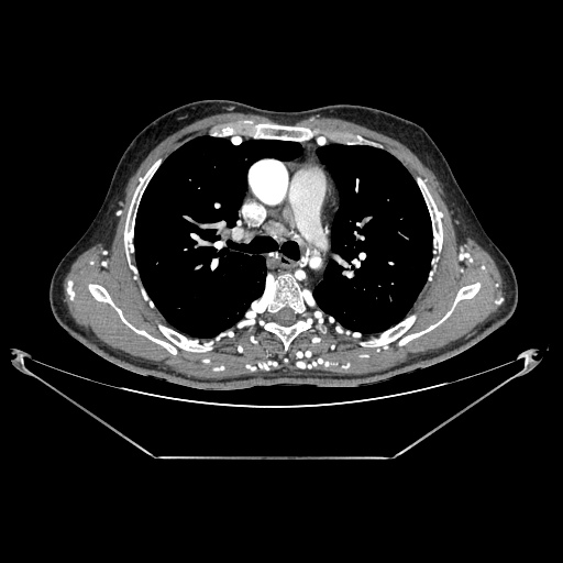Coarctation of aorta (Radiopaedia 25384-25630 A 56).jpg