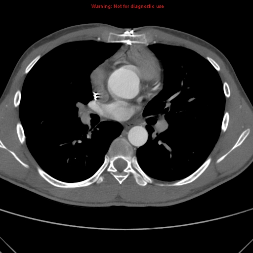 File:Coarctation of the aorta (Radiopaedia 9434-10118 A 93).jpg