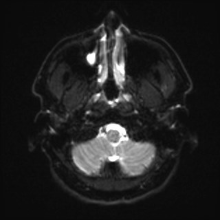 Cochlear incomplete partition type III associated with hypothalamic hamartoma (Radiopaedia 88756-105498 Axial DWI 4).jpg