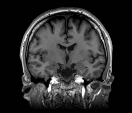 Cochlear incomplete partition type III associated with hypothalamic hamartoma (Radiopaedia 88756-105498 Coronal T1 35).jpg