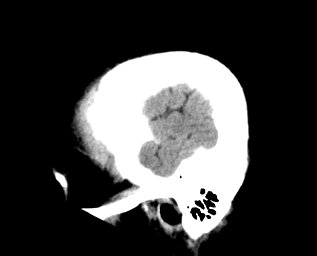 File:Colloid cyst of the third ventricle (Radiopaedia 86571-102661 B 5).png