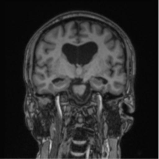 Colloid cyst of the third ventricle (Radiopaedia 86571-102662 Coronal T1 51).png