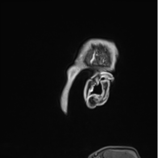 Colloid cyst of the third ventricle (Radiopaedia 86571-102662 Sagittal T1 C+ 77).png
