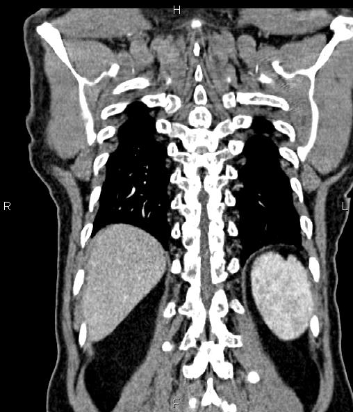 Colon adenocarcinoma (Radiopaedia 83266-97671 C 58).jpg