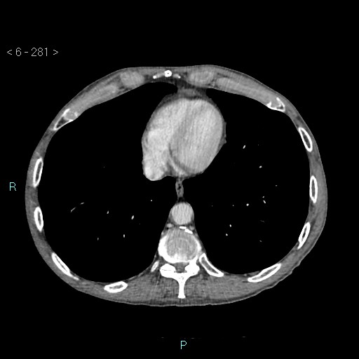Colonic cancer (ultrasound and TC imaging) (Radiopaedia 50346-55713 B 281).jpg