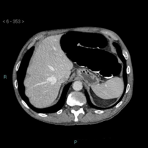 Colonic cancer (ultrasound and TC imaging) (Radiopaedia 50346-55713 B 353).jpg