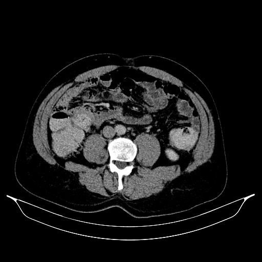 Colonic diverticulosis (Radiopaedia 72222-82744 A 42).jpg