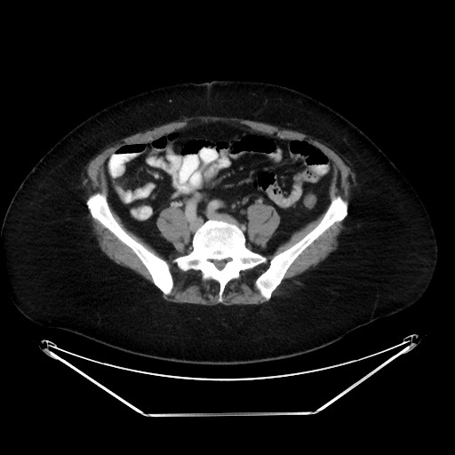 File:Colonic intussusception due to adenocarcinoma (Radiopaedia 86828-102987 A 102).jpg