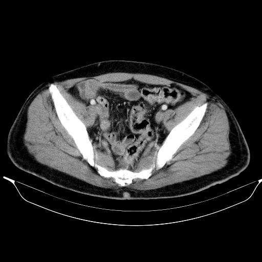 Colonic lipoma with colo-colic intussusception (Radiopaedia 58944-66200 A 56).jpg