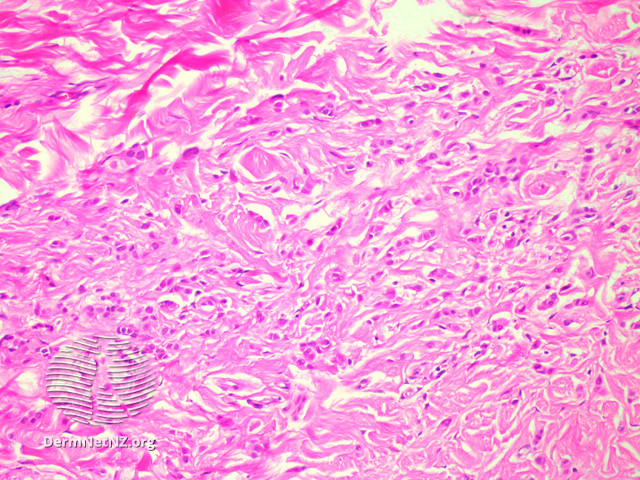 File:Figure 2 (DermNet NZ pathology-e-angiomyofibroblastoma-figure-2).jpg