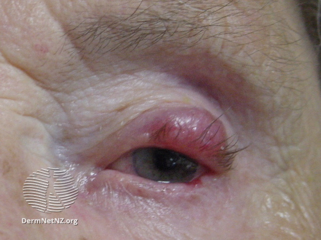 File:Merkel cell carcinoma (DermNet NZ lesions-eyelid-merkel-1).jpg