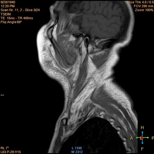File:Nasopharyngeal carcinoma (Radiopaedia 22375-22403 Sagittal T1 C+ 1).jpg