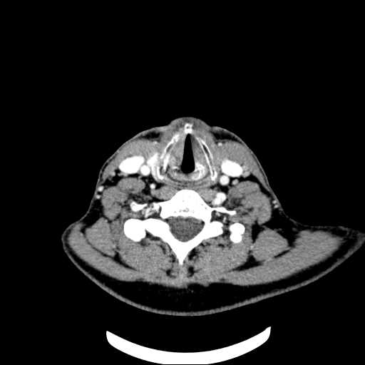 File:Nasopharyngeal carcinoma - infiltrating the clivus (Radiopaedia 62583-70875 Axial Post contrast 55).jpg