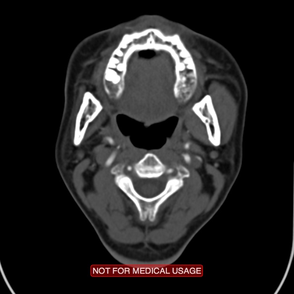File:Nasopharyngeal carcinoma recurrence - skull base destruction (Radiopaedia 29107-29491 A 16).jpg