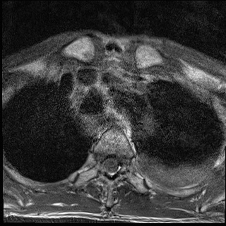 File:Nasopharyngeal carcinoma with skull base invasion (Radiopaedia 59258-66600 Axial T1 30).jpg