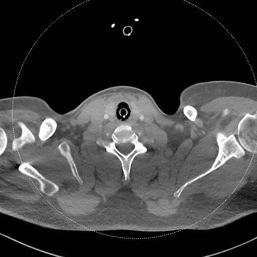 Neck CT angiogram (intraosseous vascular access) (Radiopaedia 55481-61945 B 134).jpg