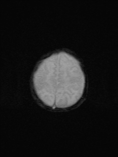 File:Neonatal hypoxic-ischemic encephalopathy (Radiopaedia 41406-44277 Axial Gradient Echo 4).jpg