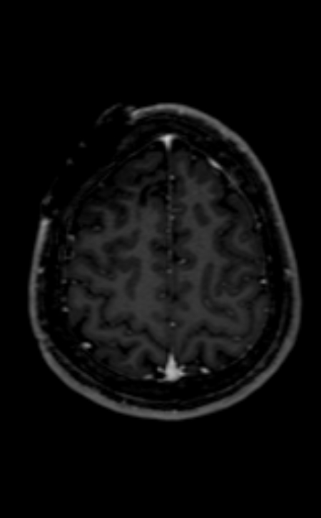 Neuro-Behçet disease (Radiopaedia 90112-107294 Axial T1 C+ 74).jpg