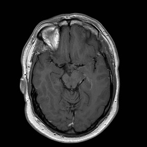 File:Neuro-Behcet's disease (Radiopaedia 21557-21506 Axial T1 C+ 12).jpg