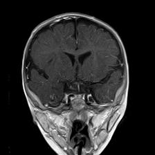 File:Neurofibromatosis type 1 (Radiopaedia 30089-30671 Coronal T1 C+ 12).jpg