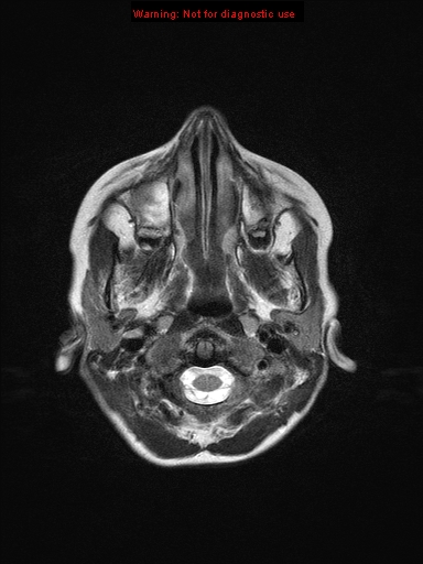 File:Neurofibromatosis type 1 with optic nerve glioma (Radiopaedia 16288-15965 Axial T2 24).jpg
