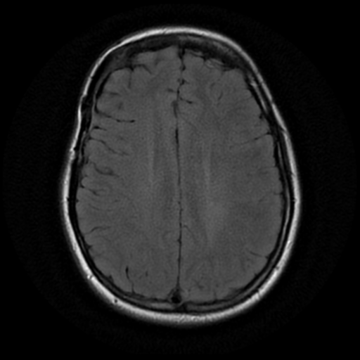 File:Neurofibromatosis type 2 (Radiopaedia 45229-49244 Axial FLAIR 14).png