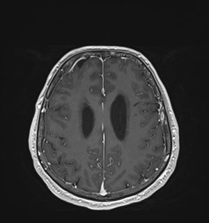 Neurofibromatosis type 2 (Radiopaedia 79097-92049 Axial T1 C+ 141).jpg