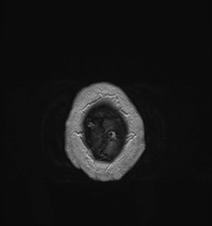 Neurofibromatosis type 2 (Radiopaedia 79097-92049 Axial T1 C+ 186).jpg