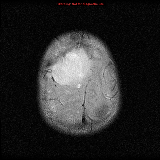 File:Neurofibromatosis type 2 (Radiopaedia 8953-9730 Axial FLAIR 23).jpg