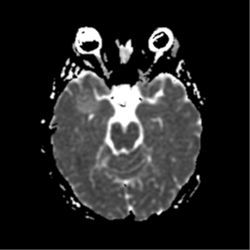 File:Neurofibromatosis type 2 - bilateral acoustic neuromata (Radiopaedia 40060-42566 Axial ADC 8).png
