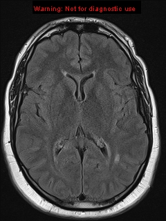File:Neuroglial cyst (Radiopaedia 10713-11184 Axial FLAIR 11).jpg