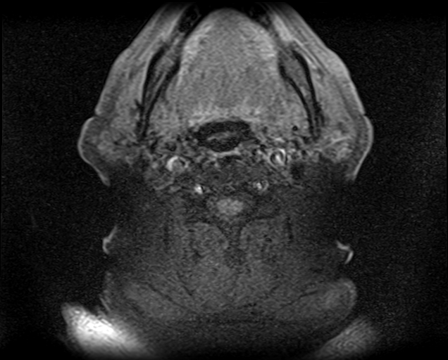 File:Non-Hodgkin lymphoma - parotid gland (Radiopaedia 71531-81890 T1 fat sat 8).jpg