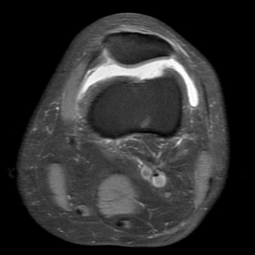 File:Non-displaced patella fracture (Radiopaedia 15932-15582 Axial PD fat sat 5).jpg