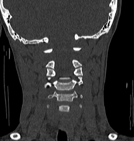 File:Normal CT cervical spine - 12-year-old (Radiopaedia 55352-61775 Coronal bone window 102).jpg