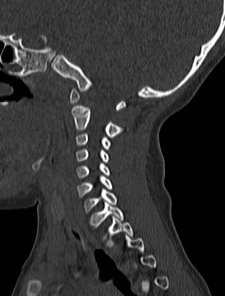 File:Normal CT cervical spine - pediatric (Radiopaedia 52549-58462 Sagittal bone window 144).jpg