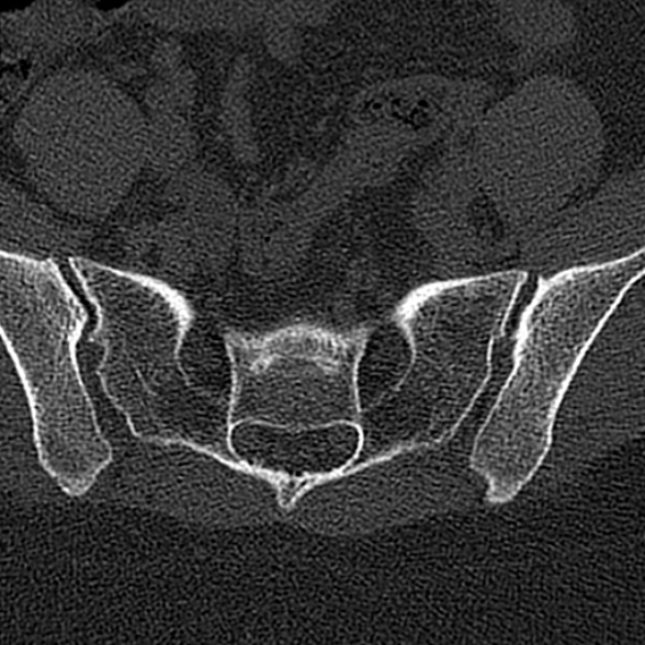 File:Normal CT lumbar spine (Radiopaedia 53981-60118 Axial bone window 73).jpg